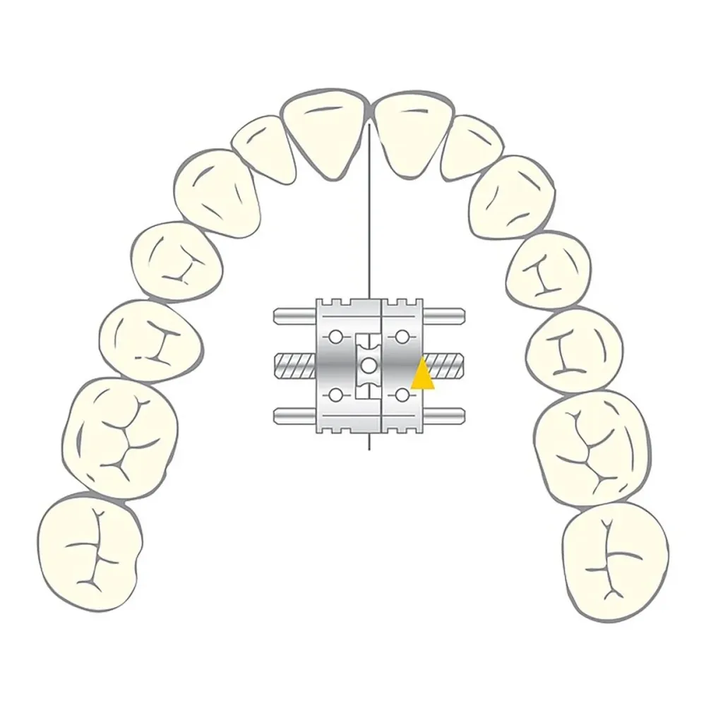 Arco de Níquel-Titanio Vector 200 compacto - cilindro de ortodoncia - scheu dental - acero inoxidable 10 u