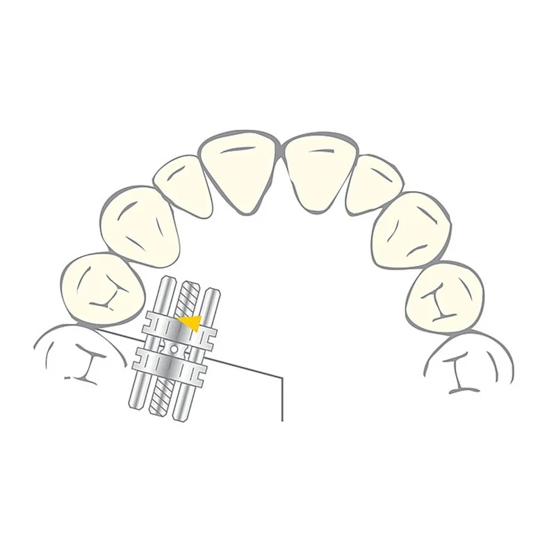 Tubo Bucal Vector 140 - Cilindro de ortodoncia dental Scheu - Acero inoxidable - 10 piezas