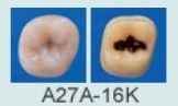 PRIMER MOLAR INSUPERABLE DERECHO 2 CAPAS -CARIES A27A-#16K